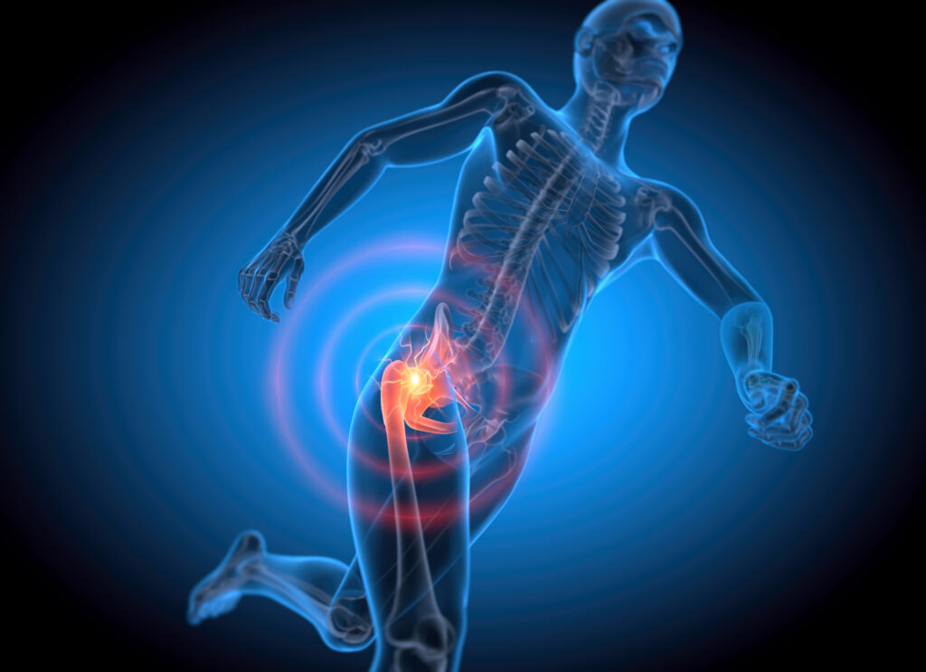 Running man painful hip joint with blue background- x-ray illustration